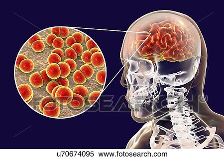 Neisseria meningitidis brain infection, computer illustration. N. meningitidis are gram-negative diplococci (spherical bacteria arranged in pairs), transmitted via the respiratory route. In most people they cause either asymptomatic infections or... View Large Photo Image Stock Photography - Neisseria meningitidis brain infection, computer illustration. N. meningitidis are gram-negative diplococci (spherical bacteria arranged in pairs), transmitted via the respiratory route. In most people they cause either asymptomatic infections or.... Fotosearch