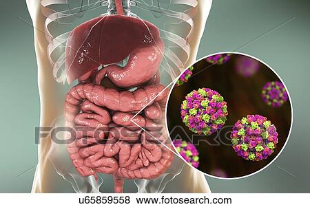 Norovirus infection, computer illustration. Norovirus is a genus of RNA (ribonucleic acid) viruses (of the family Caliciviridae), which cause about half of all gastroenteritis cases around the world. The disease is characterised by nausea, vomiting,... View Large Photo Image Stock Photo - Norovirus infection, computer illustration. Norovirus is a genus of RNA (ribonucleic acid) viruses (of the family Caliciviridae), which cause about half of all gastroenteritis cases around the world. The disease is characterised by nausea, vomiting,.... Fotosearch