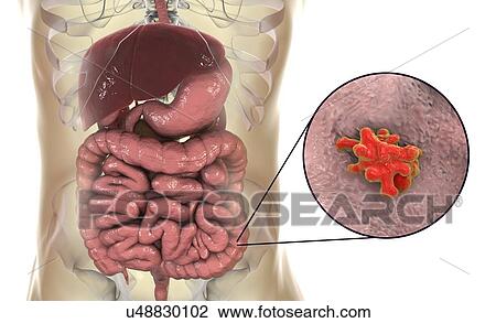 Parasitic amoeba (Entamoeba histolytica) in the large intestine, computer illustration. This single-celled organism causes amoebic dysentery and ulcers (vegetative trophozoite stage). It is spread by faecal contamination of food and water and is most... View Large Photo Image Stock Image - Parasitic amoeba (Entamoeba histolytica) in the large intestine, computer illustration. This single-celled organism causes amoebic dysentery and ulcers (vegetative trophozoite stage). It is spread by faecal contamination of food and water and is most.... Fotosearch