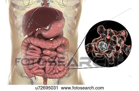 Parasitic amoeba (Entamoeba histolytica) in the large intestine, computer illustration. This single-celled organism causes amoebic dysentery and ulcers (vegetative trophozoite stage). It is spread by faecal contamination of food and water and is most... View Large Photo Image Stock Image - Parasitic amoeba (Entamoeba histolytica) in the large intestine, computer illustration. This single-celled organism causes amoebic dysentery and ulcers (vegetative trophozoite stage). It is spread by faecal contamination of food and water and is most.... Fotosearch