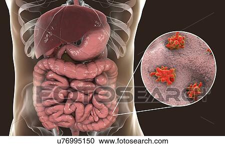 Parasitic amoeba (Entamoeba histolytica) in the large intestine, computer illustration. This single-celled organism causes amoebic dysentery and ulcers (vegetative trophozoite stage). It is spread by faecal contamination of food and water and is most... View Large Photo Image Stock Image - Parasitic amoeba (Entamoeba histolytica) in the large intestine, computer illustration. This single-celled organism causes amoebic dysentery and ulcers (vegetative trophozoite stage). It is spread by faecal contamination of food and water and is most.... Fotosearch