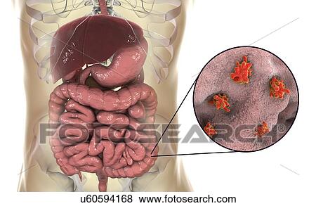 Parasitic amoeba (Entamoeba histolytica) in the large intestine, computer illustration. This single-celled organism causes amoebic dysentery and ulcers (vegetative trophozoite stage). It is spread by faecal contamination of food and water and is most... View Large Photo Image Stock Photo - Parasitic amoeba (Entamoeba histolytica) in the large intestine, computer illustration. This single-celled organism causes amoebic dysentery and ulcers (vegetative trophozoite stage). It is spread by faecal contamination of food and water and is most.... Fotosearch