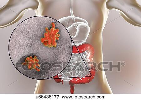 Parasitic amoeba (Entamoeba histolytica) in the large intestine, computer illustration. This single-celled organism causes amoebic dysentery and ulcers (vegetative trophozoite stage). It is spread by faecal contamination of food and water and is most... View Large Photo Image Stock Photo - Parasitic amoeba (Entamoeba histolytica) in the large intestine, computer illustration. This single-celled organism causes amoebic dysentery and ulcers (vegetative trophozoite stage). It is spread by faecal contamination of food and water and is most.... Fotosearch