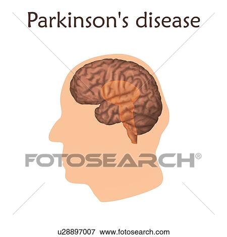 Stock Photo - Parkinson's disease, illustration. Diminished Substantia Nigra in the brain.. Fotosearch