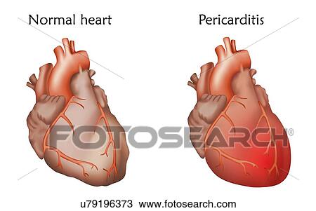 Stock Image - Pericarditis, illustration. Comparison between a normal heart and one with pericarditis, or inflammation of the pericardium.. Fotosearch