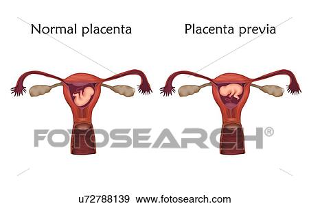 Placenta previa and normal pregnancy comparison, illustration. In placenta previa the placenta covers the cervical opening. View Large Photo Image Stock Photo - Placenta previa and normal pregnancy comparison, illustration. In placenta previa the placenta covers the cervical opening.. Fotosearch
