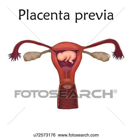 Stock Photograph - Placenta previa, illustration. This is a condition where the placenta partially or fully covers the cervix.. Fotosearch