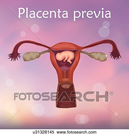 Placenta previa, illustration. This is a condition where the placenta covers the cervical opening. View Large Photo Image Stock Photography - Placenta previa, illustration. This is a condition where the placenta covers the cervical opening.. Fotosearch