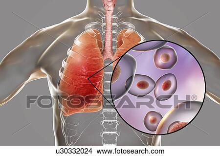 Picture - Pneumocystis pneumonia, conceptual computer illustration. This lung infection is the most common opportunistic illness in people infected with HIV (Human Immunodeficiency Virus) and is caused by the fungus Pneumocystis jaroveci (previously P..... Fotosearch