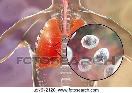 Stock Image - Pneumocystis pneumonia, conceptual computer illustration. This lung infection is the most common opportunistic illness in people infected with HIV (Human Immunodeficiency Virus) and is caused by the fungus Pneumocystis jaroveci (previously P..... Fotosearch