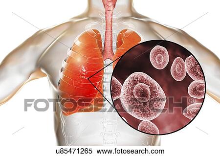 Stock Photography - Pneumocystis pneumonia, conceptual computer illustration. This lung infection is the most common opportunistic illness in people infected with HIV (Human Immunodeficiency Virus) and is caused by the fungus Pneumocystis jaroveci (previously P..... Fotosearch