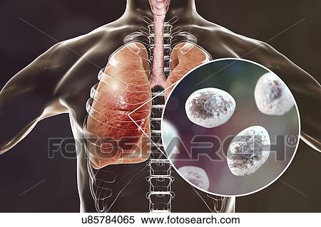 Pneumocystis pneumonia, conceptual computer illustration. This lung infection is the most common opportunistic illness in people infected with HIV (Human Immunodeficiency Virus) and is caused by the fungus Pneumocystis jaroveci (previously P.... View Large Photo Image Stock Photography - Pneumocystis pneumonia, conceptual computer illustration. This lung infection is the most common opportunistic illness in people infected with HIV (Human Immunodeficiency Virus) and is caused by the fungus Pneumocystis jaroveci (previously P..... Fotosearch
