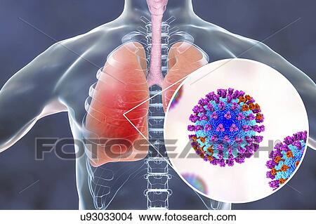 Picture - Pneumonia caused by flu, computer illustration. Pneumonia is one of the common complications of a flu infection.. Fotosearch