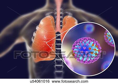 Pneumonia caused by flu, computer illustration. Pneumonia is one of the common complications of a flu infection. View Large Photo Image Stock Photograph - Pneumonia caused by flu, computer illustration. Pneumonia is one of the common complications of a flu infection.. Fotosearch