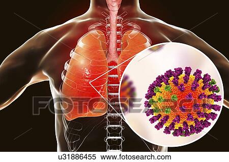 Stock Photography - Pneumonia caused by flu, computer illustration. Pneumonia is one of the common complications of a flu infection.. Fotosearch