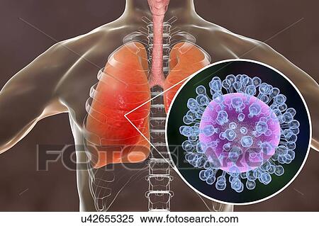 Stock Photography - Pneumonia caused by flu, computer illustration. Pneumonia is one of the common complications of a flu infection.. Fotosearch