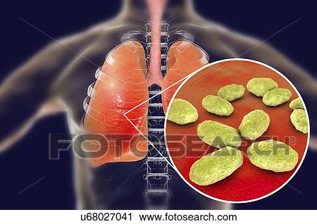 Pneumonia caused by Haemophilus influenzae bacteria, computer illustration. H. influenzae are coccobacillus Gram-negative bacteria. These bacteria cause a number of diseases including meningitis in children, pneumonia, epiglottitis, laryngitis,... View Large Photo Image Stock Image - Pneumonia caused by Haemophilus influenzae bacteria, computer illustration. H. influenzae are coccobacillus Gram-negative bacteria. These bacteria cause a number of diseases including meningitis in children, pneumonia, epiglottitis, laryngitis,.... Fotosearch