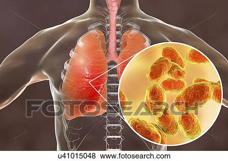 Stock Photo - Pneumonia caused by Haemophilus influenzae bacteria, computer illustration. H. influenzae are coccobacillus Gram-negative bacteria. These bacteria cause a number of diseases including meningitis in children, pneumonia, epiglottitis, laryngitis,.... Fotosearch