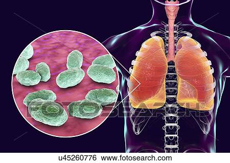 Pneumonia caused by Haemophilus influenzae bacteria, computer illustration. H. influenzae are coccobacillus Gram-negative bacteria. These bacteria cause a number of diseases including meningitis in children, pneumonia, epiglottitis, laryngitis,... View Large Photo Image Stock Photograph - Pneumonia caused by Haemophilus influenzae bacteria, computer illustration. H. influenzae are coccobacillus Gram-negative bacteria. These bacteria cause a number of diseases including meningitis in children, pneumonia, epiglottitis, laryngitis,.... Fotosearch