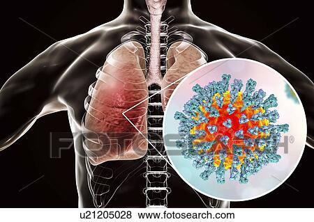 Stock Photo - Pneumonia caused by measles viruses, conceptual computer illustration. Measles virus, from the Morbillivirus group of viruses, consists of an RNA (ribonucleic acid) core surrounded by an envelope studded with surface proteins.... Fotosearch