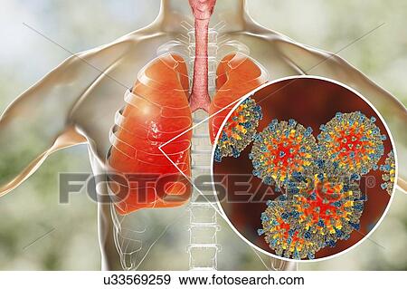 Pneumonia caused by measles viruses, conceptual computer illustration. Measles virus, from the Morbillivirus group of viruses, consists of an RNA (ribonucleic acid) core surrounded by an envelope studded with surface proteins... View Large Photo Image Stock Photo - Pneumonia caused by measles viruses, conceptual computer illustration. Measles virus, from the Morbillivirus group of viruses, consists of an RNA (ribonucleic acid) core surrounded by an envelope studded with surface proteins.... Fotosearch