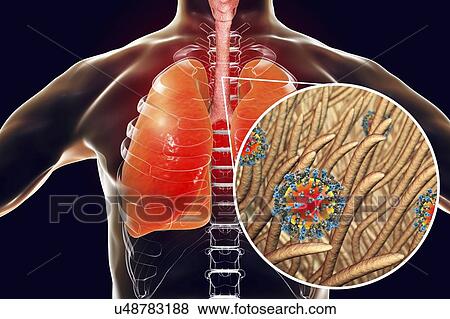 Stock Photo - Pneumonia caused by measles viruses, conceptual computer illustration. Measles virus, from the Morbillivirus group of viruses, consists of an RNA (ribonucleic acid) core surrounded by an envelope studded with surface proteins.... Fotosearch