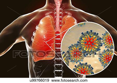 Stock Photo - Pneumonia caused by measles viruses, conceptual computer illustration. Measles virus, from the Morbillivirus group of viruses, consists of an RNA (ribonucleic acid) core surrounded by an envelope studded with surface proteins.... Fotosearch