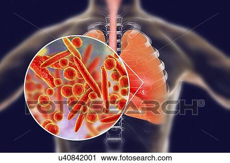 Stock Image - Pneumonia caused by Mycoplasma pneumoniae bacteria, conceptual computer illustration. Mycoplasmas are the smallest cellular organisms known (diameter 0. 3-0. 9 microns). They resemble bacteria in some respects (some authorities regard them as primitive.... Fotosearch