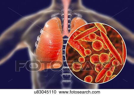 Stock Image - Pneumonia caused by Mycoplasma pneumoniae bacteria, conceptual computer illustration. Mycoplasmas are the smallest cellular organisms known (diameter 0. 3-0. 9 microns). They resemble bacteria in some respects (some authorities regard them as primitive.... Fotosearch