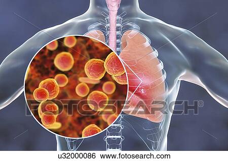 Pneumonia caused by Mycoplasma pneumoniae bacteria, conceptual computer illustration. Mycoplasmas are the smallest cellular organisms known (diameter 0. 3-0. 9 microns). They resemble bacteria in some respects (some authorities regard them as primitive... View Large Photo Image Stock Photograph - Pneumonia caused by Mycoplasma pneumoniae bacteria, conceptual computer illustration. Mycoplasmas are the smallest cellular organisms known (diameter 0. 3-0. 9 microns). They resemble bacteria in some respects (some authorities regard them as primitive.... Fotosearch