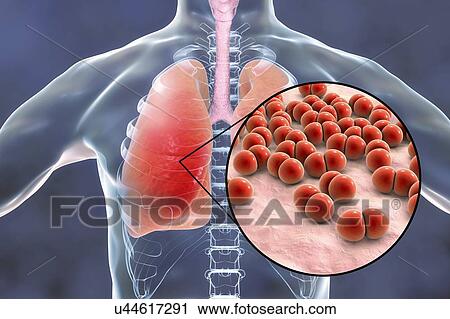 Stock Image - Pneumonia caused by Streptococcus pneumoniae bacteria, conceptual computer illustration. S. pneumoniae bacteria are Gram-positive diplococci (arranged in pairs), they are the main cause of community acquired pneumonia in children and the elderly.. Fotosearch