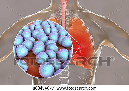 Pneumonia caused by Streptococcus pneumoniae bacteria, conceptual computer illustration. S. pneumoniae bacteria are Gram-positive diplococci (arranged in pairs), they are the main cause of community acquired pneumonia in children and the elderly. View Large Photo Image Stock Photo - Pneumonia caused by Streptococcus pneumoniae bacteria, conceptual computer illustration. S. pneumoniae bacteria are Gram-positive diplococci (arranged in pairs), they are the main cause of community acquired pneumonia in children and the elderly.. Fotosearch