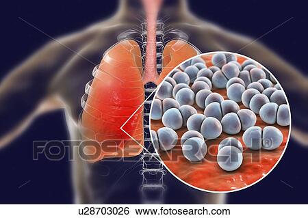 Stock Photograph - Pneumonia caused by Streptococcus pneumoniae bacteria, conceptual computer illustration. S. pneumoniae bacteria are Gram-positive diplococci (arranged in pairs), they are the main cause of community acquired pneumonia in children and the elderly.. Fotosearch