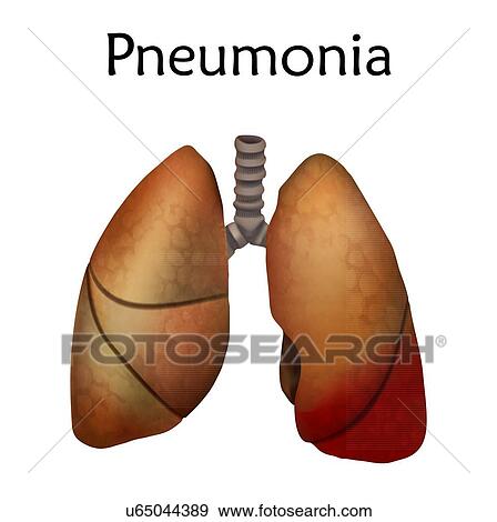 Pneumonia, illustration. An inflammatory condition of the lung. View Large Photo Image Stock Photo - Pneumonia, illustration. An inflammatory condition of the lung.. Fotosearch