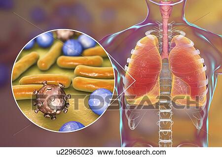 Stock Image - Pneumonia of mixed etiology, conceptual illustration. Human lungs and close-up view of bacteria and viruses, two of the causative agents of pneumonia.. Fotosearch