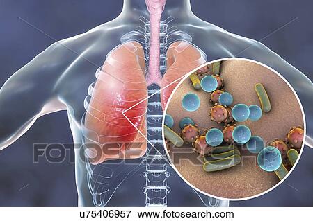 Stock Photo - Pneumonia of mixed etiology, conceptual illustration. Human lungs and close-up view of bacteria and viruses, two of the causative agents of pneumonia.. Fotosearch
