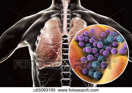Stock Photography - Pneumonia of mixed etiology, conceptual illustration. Human lungs and close-up view of bacteria and viruses, two of the causative agents of pneumonia.. Fotosearch