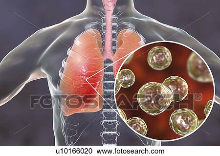 Stock Image - Pulmonary blastomycosis, conceptual illustration. Blastomyces dermatitidis fungus is the causative agent of the disease blastomycosis, which has a range of presentations. It mainly affects the lungs and may cause a flu-like disease, an acute disease.... Fotosearch