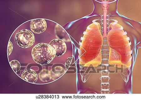 Stock Image - Pulmonary blastomycosis, conceptual illustration. Blastomyces dermatitidis fungus is the causative agent of the disease blastomycosis, which has a range of presentations. It mainly affects the lungs and may cause a flu-like disease, an acute disease.... Fotosearch