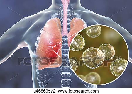 Stock Image - Pulmonary blastomycosis, conceptual illustration. Blastomyces dermatitidis fungus is the causative agent of the disease blastomycosis, which has a range of presentations. It mainly affects the lungs and may cause a flu-like disease, an acute disease.... Fotosearch