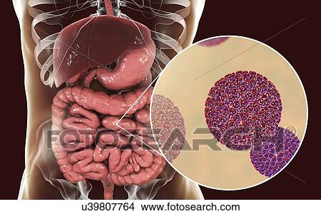 Picture - Rotaviruses infecting intestine, computer illustration. The virus particle consists of an RNA (ribonucleic acid) core surrounded by a triple layered capsid. Rotaviruses are probably the most common viruses to infect humans and animals. They are.... Fotosearch