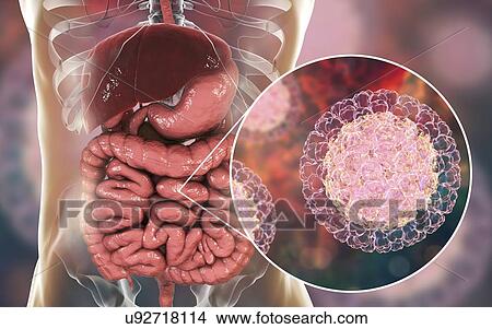 Picture - Rotaviruses infecting intestine, computer illustration. The virus particle consists of an RNA (ribonucleic acid) core surrounded by a triple layered capsid. Rotaviruses are probably the most common viruses to infect humans and animals. They are.... Fotosearch