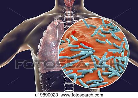 Stock Image - Secondary tuberculosis infection and close-up view of Mycobacterium tuberculosis bacteria, the causative agent of tuberculosis. Computer illustration showing small-sized solid nodular mass located in the upper lobe of right lung near lung apex.. Fotosearch