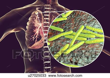 Secondary tuberculosis infection and close-up view of Mycobacterium tuberculosis bacteria, the causative agent of tuberculosis. Computer illustration showing small-sized solid nodular mass located in the upper lobe of right lung near lung apex. View Large Photo Image Stock Image - Secondary tuberculosis infection and close-up view of Mycobacterium tuberculosis bacteria, the causative agent of tuberculosis. Computer illustration showing small-sized solid nodular mass located in the upper lobe of right lung near lung apex.. Fotosearch