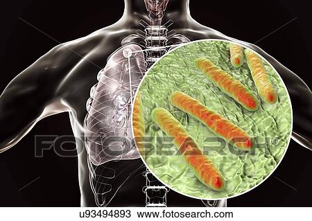 Stock Image - Secondary tuberculosis infection and close-up view of Mycobacterium tuberculosis bacteria, the causative agent of tuberculosis. Computer illustration showing small-sized solid nodular mass located in the upper lobe of right lung near lung apex.. Fotosearch
