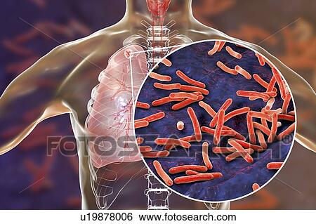 Secondary tuberculosis infection and close-up view of Mycobacterium tuberculosis bacteria, the causative agent of tuberculosis. Computer illustration showing small-sized solid nodular mass located in the upper lobe of right lung near lung apex. View Large Photo Image Stock Photograph - Secondary tuberculosis infection and close-up view of Mycobacterium tuberculosis bacteria, the causative agent of tuberculosis. Computer illustration showing small-sized solid nodular mass located in the upper lobe of right lung near lung apex.. Fotosearch