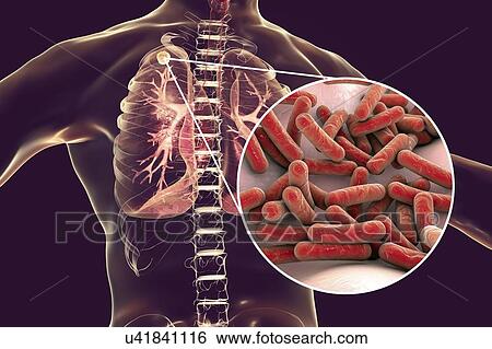 Stock Photograph - Secondary tuberculosis infection and close-up view of Mycobacterium tuberculosis bacteria, the causative agent of tuberculosis. Computer illustration showing small-sized solid nodular mass located in the upper lobe of right lung near lung apex.. Fotosearch