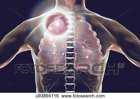Stock Photograph - Secondary tuberculosis infection and close-up view of Mycobacterium tuberculosis bacteria, the causative agent of tuberculosis. Computer illustration showing small-sized solid nodular mass located in the upper lobe of right lung near lung apex.. Fotosearch