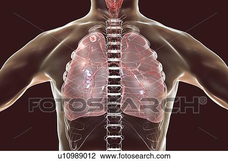 Secondary tuberculosis infection. Computer illustration showing small-sized solid nodular mass located in the upper lobe of right lung near lung apex. View Large Photo Image Stock Image - Secondary tuberculosis infection. Computer illustration showing small-sized solid nodular mass located in the upper lobe of right lung near lung apex.. Fotosearch