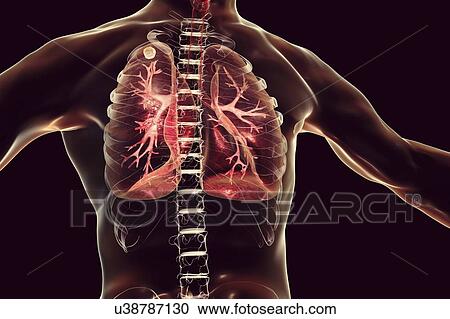Secondary tuberculosis infection. Computer illustration showing small-sized solid nodular mass located in the upper lobe of right lung near lung apex. View Large Photo Image Stock Image - Secondary tuberculosis infection. Computer illustration showing small-sized solid nodular mass located in the upper lobe of right lung near lung apex.. Fotosearch